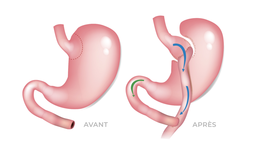 Le Bypass Gastrique